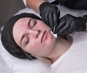 Blackhead facial performed by professional esthetician