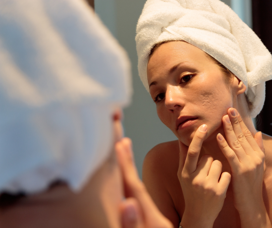 You are currently viewing Safe Facials for Acne Scars