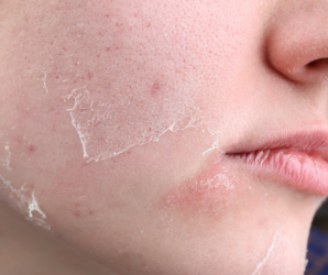 Dry and peeling skin on face